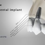 Co - Axis: Angled Dental Implant