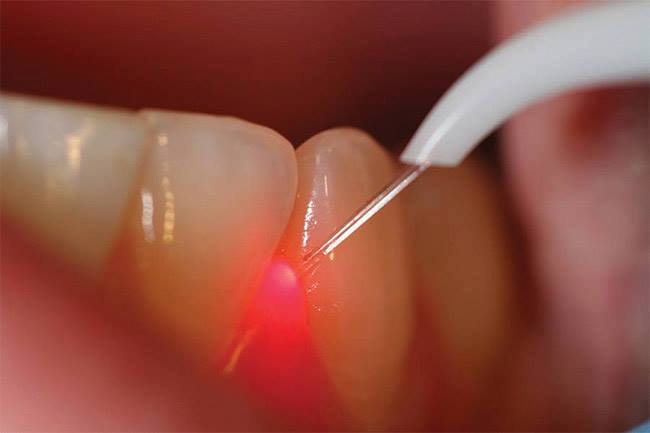 Soft tissue Lasers