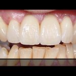 ΤΣΑΝΑΚΤΣΙΔΗΣ ΔΗΜΗΤΡΗΣ/Όψεις πορσελάνης & αυχενικές εμφράξεις & λεύκανση δοντιών