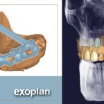 EXOPLAN - ΕΧΟCAD: Πρόγραμμα σχεδιασμού για χειρουργικούς νάρθηκες και ψηφιακή τοποθέτηση εμφυτευμάτων