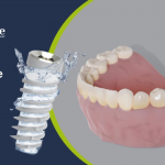 Υδρόφιλη τεχνολογία εμφυτευμάτων Bioactive από την Stergiou Κ. Dental