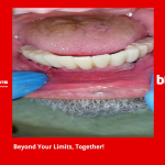 All-On-6 αποκατάσταση κάτω γνάθου με άμεση φόρτιση 6 εμφυτευμάτων Btk Dental Is+ (Bone Level) - Dental Roots