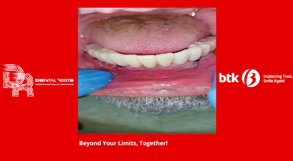 All-On-6 αποκατάσταση κάτω γνάθου με άμεση φόρτιση 6 εμφυτευμάτων Btk Dental Is+ (Bone Level) – Dental Roots