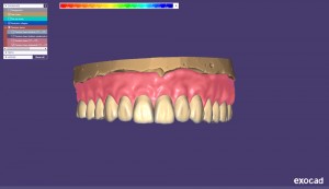 Περιστατικό με ψηφιακή ολική και μερική οδοντοστοιχία με exocad