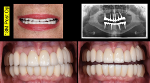 Full arch immediate loading optimised with Southern Implants & DSD