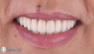 Full mouth reconstruction with full mouth extractions, immediate implant placement and SameDay teeth