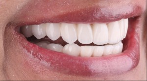 Managment of anaesthetic and uneven gumy smile with exctraction of unrestorable teeth leveling of the gum line, immediate implant placement and SameDay teeth