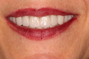 Before after full mouth treatment with Zirconia bridges