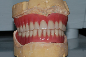 Κατασκευή επένθετων οδοντοστοιχιών σε δοκό